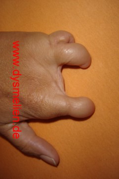 Bild einer Hand mit Dysmelie - Bildquelle: www.dysmelien.de